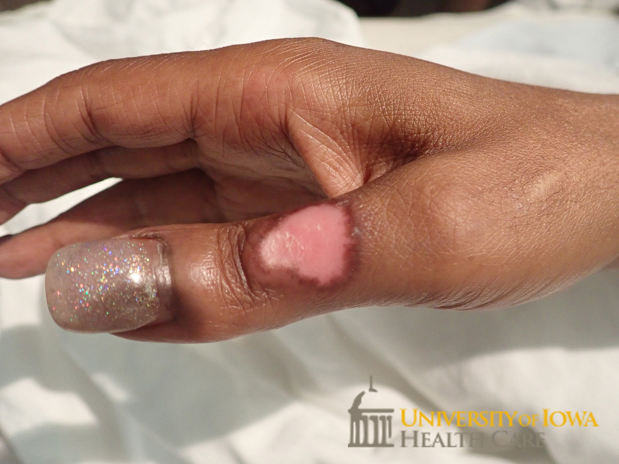Well demaracated, shiny, and atrophic plaque with central depigmentation and with rim of hyperpigmentation and central scale on the thumb. (click images for higher resolution).